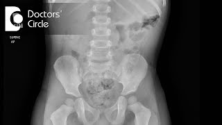 How to diagnose Intussusception  Dr Nagaraj B Puttaswamy [upl. by Delle803]