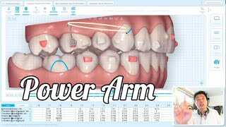 Invisalign Power Arm attachment feature [upl. by Lebyram]