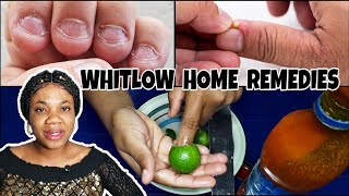 HOME REMEDIES FOR BACTERIAL FINGER WHITLOWHANGNAIL INFECTIONPARONYCHIA  Dont pull your hangnails [upl. by Harlan]