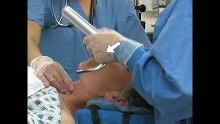 Orotracheal Intubation [upl. by Oren]