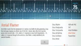 Atrial Arrhythmias NSR Atrial Flutter Atrial Fibrillation [upl. by Euqinim394]