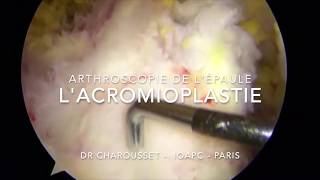 Lacromioplastie de lépaule sous arthroscopie par le Dr CHAROUSSET [upl. by Ness]