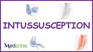 Intussusception  causes types  pathophysiologyfeaturesdx and treatment [upl. by Orola]