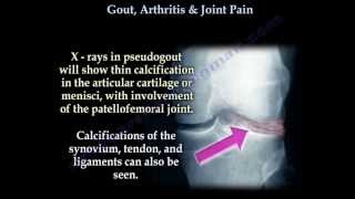 Arthrodesis Big Toe Fusion  Walking Pre and Post Op [upl. by Ayerhs]