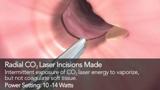 Tracheal Stenosis Animation with CO2 Laser Fiber [upl. by Duncan638]