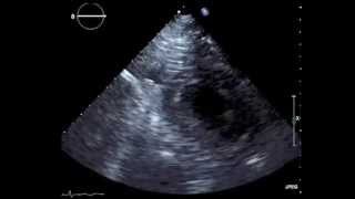 Transthoracic Echocardiography [upl. by Atteuqihc]