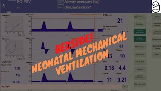 Bedside Neonatal Mechanical ventilation [upl. by Nosille394]