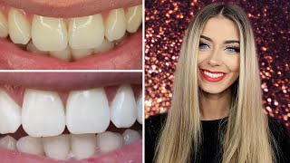 How I Whitened My Teeth at Home  Danielle Mansutti [upl. by Packston]