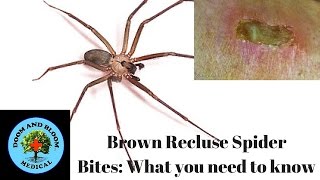 Brown Recluse Spider Bites What you need to know [upl. by Lekzehcey]