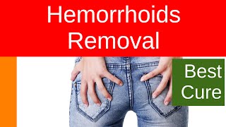 Hemorrhoids Removal [upl. by Clemmie]