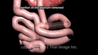 Intussusception Treatment video  Animaton by Cal Shipley MD [upl. by Aneehsyt217]