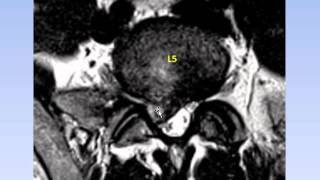 Dr Gillard Lectures on Lumbar Disc Herniation  Protrusion Part II of II [upl. by Bary]