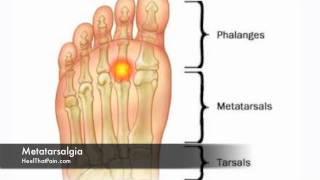 Heel Spur Treatment – How to Avoid Heel Spur Surgery  Seattle Podiatrist [upl. by Lebanna467]