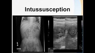 Intussusception [upl. by Denby]