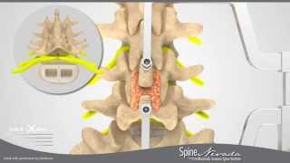 Minimally Invasive Spine Surgery ILIF Interlaminar Lumbar Fusion in Sparks Reno Carson [upl. by Eizeerb]