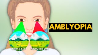 Amblyopia Causes Signs and Symptoms Diagnosis and Treatment [upl. by Raynard519]