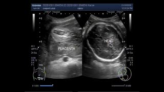 Ultrasound Video showing Oligohydromnios  almost Anhydramnios  with Pregnancy of 30 weeks [upl. by Luhem]