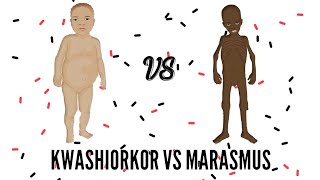 SAM  Severe Acute Malnutrition  Kwashiorkor VS Marasmus [upl. by Chavaree]