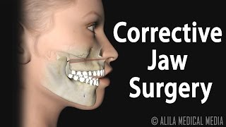 Corrective Jaw Orthognathic Surgery Animation [upl. by Jt]