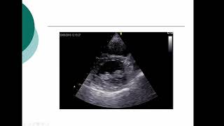 Lecture 3  Transthoracic Echocardiography Part 2 [upl. by Yclehc]