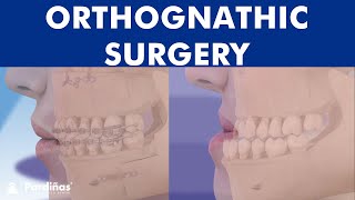 ORTHOGNATHIC surgery  All about JAW realignment surgery © [upl. by Deevan]