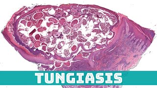 Tungiasis Sand Flea Under the Microscope Tunga penetrans aka jigger flea skin pathology [upl. by Dowdell848]