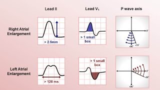 Intro to EKG Interpretation  Chamber Enlargement [upl. by Hephzipa480]