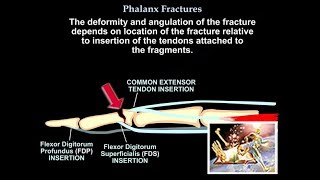 Osteoarthritis  causes symptoms diagnosis treatment amp pathology [upl. by Toile]