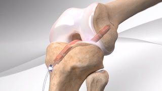 Calcaneal Fracture Classifications  Everything You Need To Know  Dr Nabil Ebraheim [upl. by Esmaria]