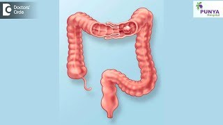 What is the treatment for Intussusception  Dr Nagaraj B Puttaswamy [upl. by Mecke]