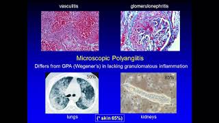 Identifying Urticaria and its Homeopathic management  Dr Ramesh Babu N [upl. by Atteuqahs]