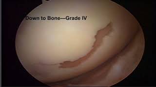 Knee Chondromalcia and Its Treatment [upl. by Yma]