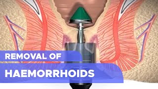 Removal of Haemorrhoids [upl. by Eatnhoj643]