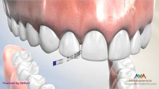 Interproximal Reduction or IPR  Polishing Strip [upl. by Nwahser]