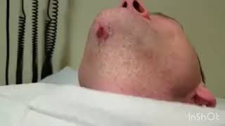 Huge ingrown hair [upl. by Naneek]