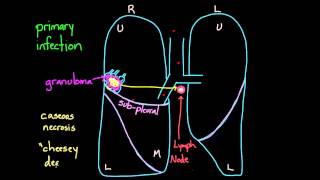 Primary and Secondary TB [upl. by Mattah]