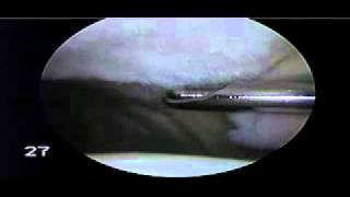 Chondroplasty Patella for Chondromalacia Patella  Dr Steven Struhl [upl. by Ushijima377]