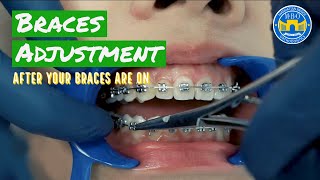 How Do Braces Straighten Teeth [upl. by Culbertson]