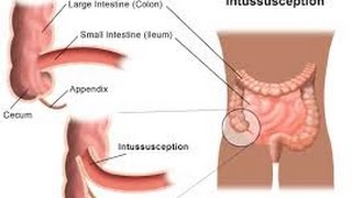 Intussusception [upl. by Chemar]