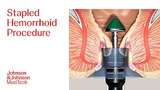 PPH Procedure Animation  Stapled Hemorrhoid Surgery  JampJ MedTech [upl. by Glynias]