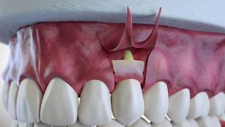 Subepithelial Connective Tissue Grafting [upl. by Nnaasil]