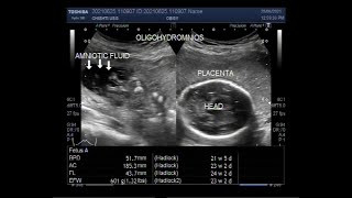 Oligohydramnios with loss of fetal movements and Pregnancy of about 23 weeks [upl. by Aivila]