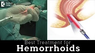 Laser Hemorrhoidoplasty vs Open Hemorrhoidectomy  Hemorrhoid Treatment  Dr Rajasekhar M R [upl. by Assilram]