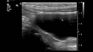 Intussusception US and Reductionmp4 [upl. by Elik]