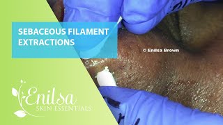 Sebaceous Filament Extractions [upl. by Jenks]