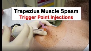 Trapezius Muscle Spasm Trigger Point Injection [upl. by Archambault10]