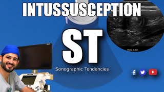 Intussusception Ultrasound [upl. by Mclaurin245]