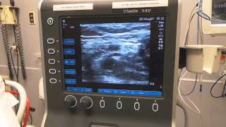 Ultrasound Guided Intravenous Access [upl. by Langill185]