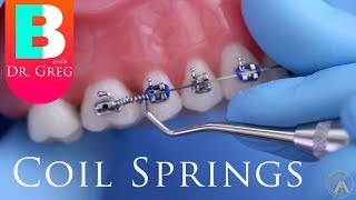 BRACES EXPLAINED Coil Springs [upl. by Gorman]