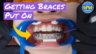 Process of Getting Braces [upl. by Michelina]